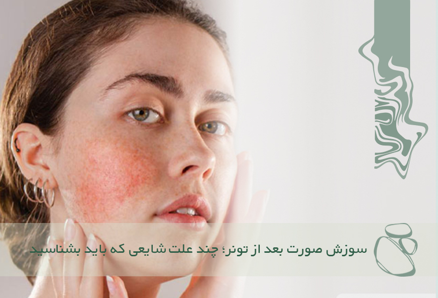 سوزش صورت بعد از تونر؛ چند علت شایعی که باید بشناسید